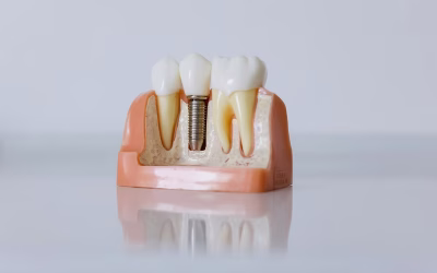 🦷 Implantes dentales en Leganés: la solución definitiva para recuperar tu sonrisa.